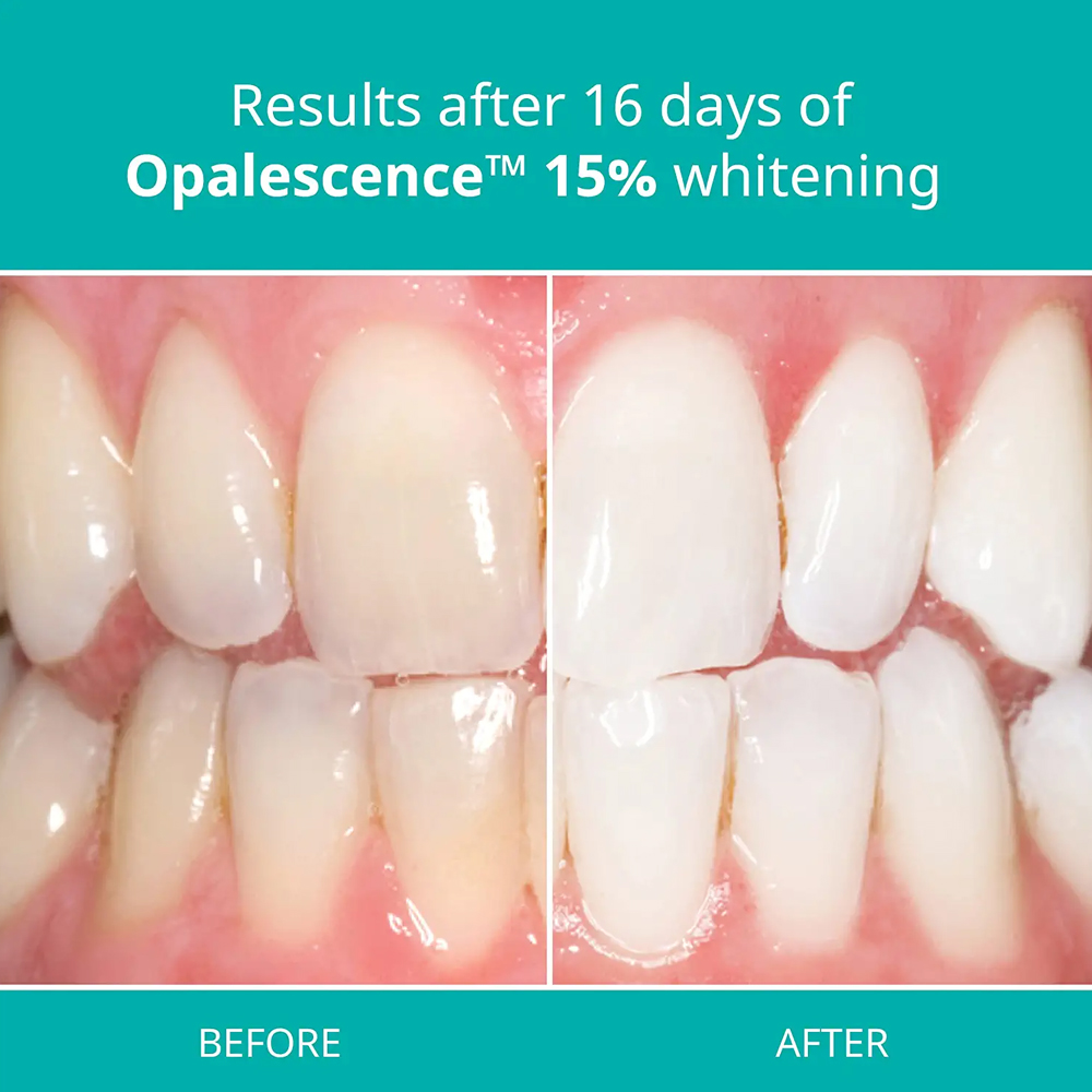 Kit doméstico de gel para clar - Teeth Whitening Gel Opalescence avaliação e preço
