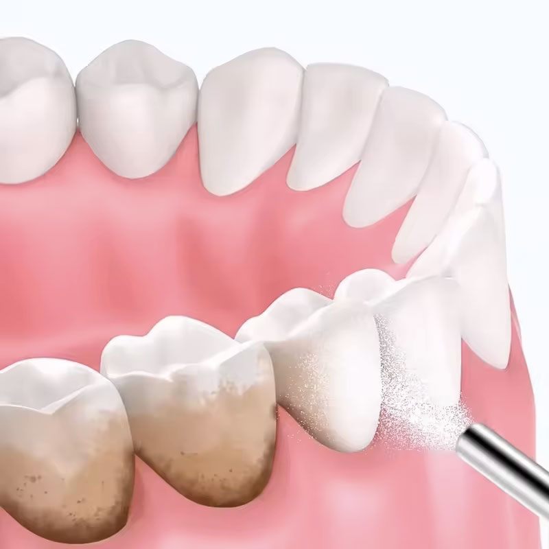 Pó para Jato de Areia Dental 1 - Teeth Whitening Co avaliação e preço
