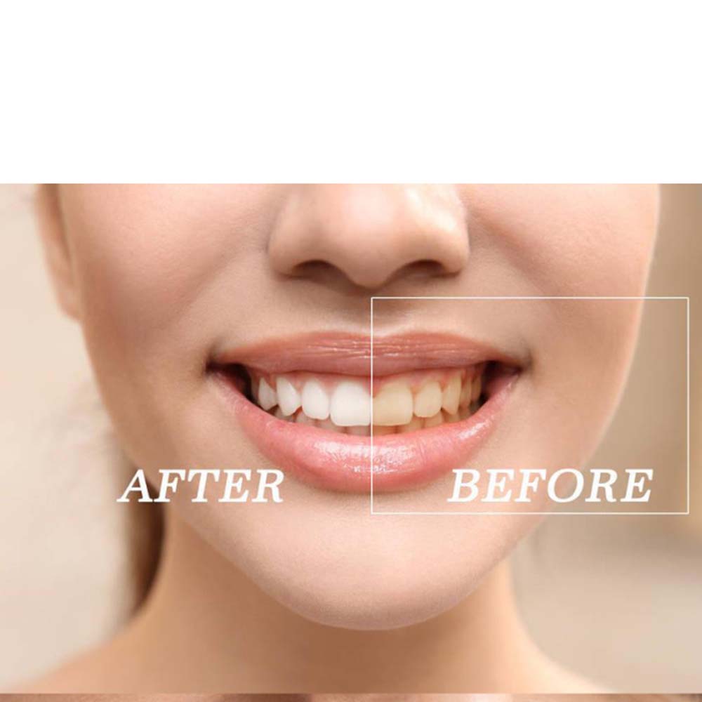 Kit de gel para clareamento de - Teeth Whitening Kit With Light avaliação e preço