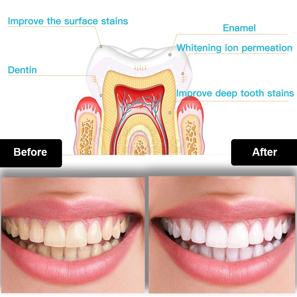 Kit de clareamento dental dos  - Teeth Whitening Kit With Light avaliação e preço